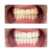 Diodenta Teeth Whitening Gel