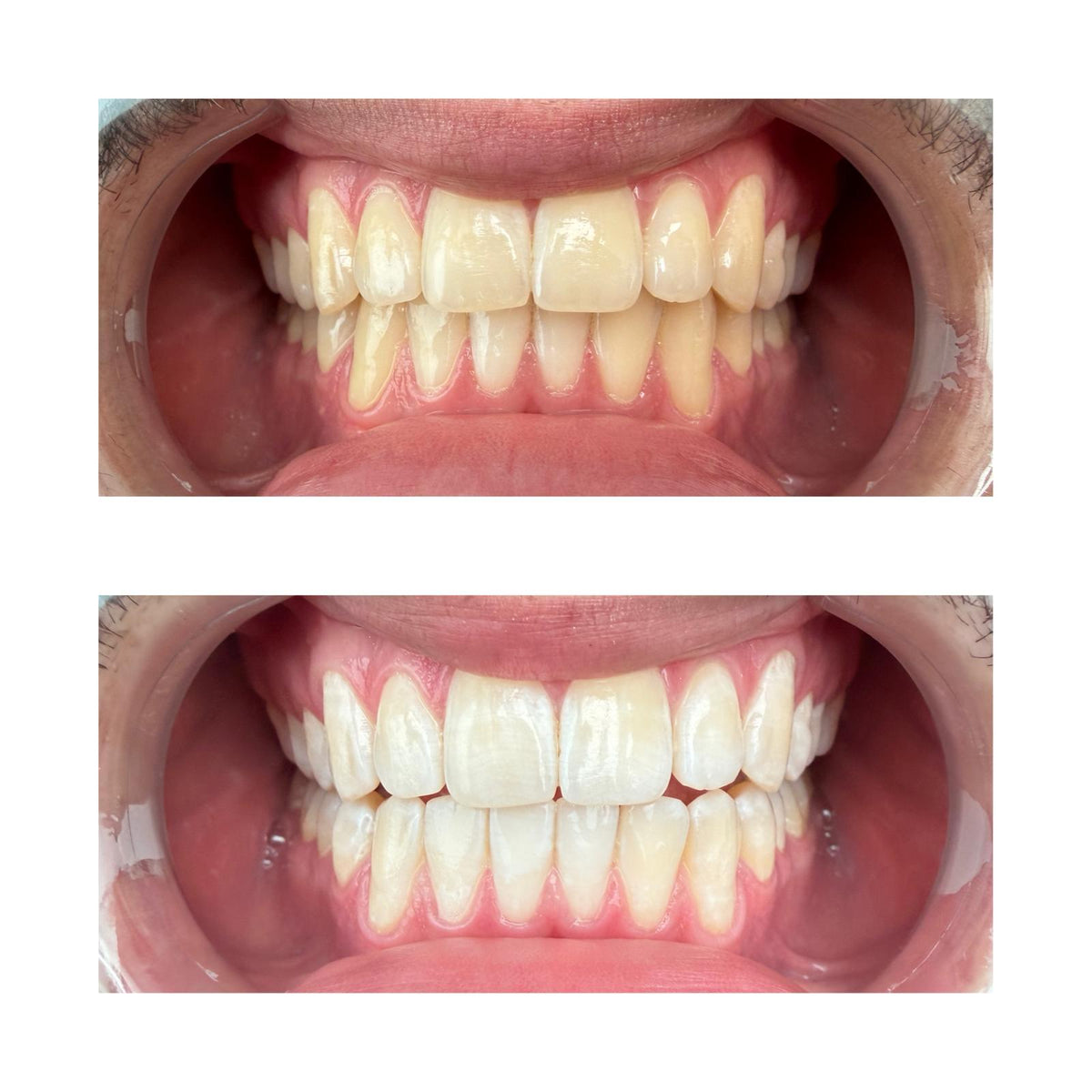 Diodenta Teeth Whitening Gel
